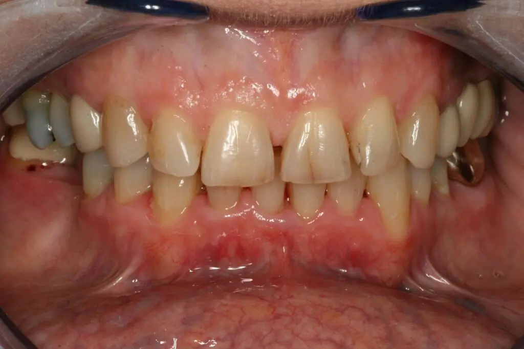 before